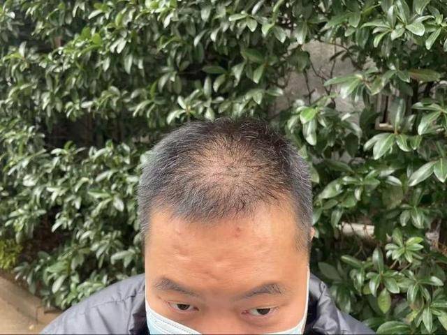 “还能反光<strong></p>
<p>贵金属kdj指标详解</strong>！”长沙男子植发近9月称后脑勺“像狗啃过”