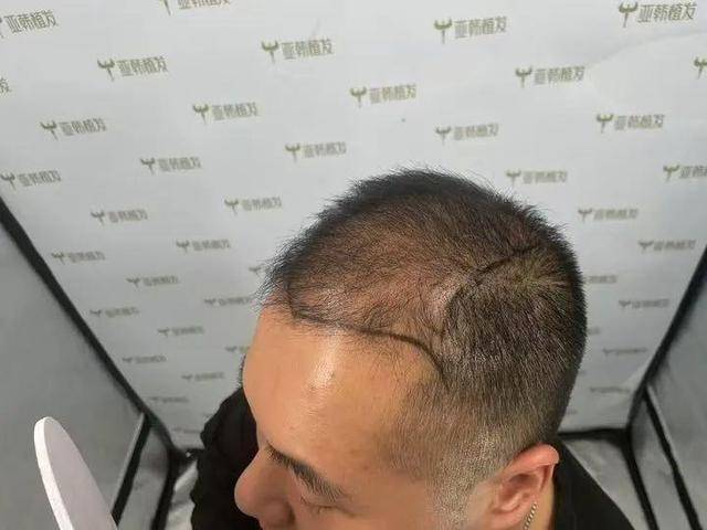 “还能反光<strong></p>
<p>贵金属kdj指标详解</strong>！”长沙男子植发近9月称后脑勺“像狗啃过”