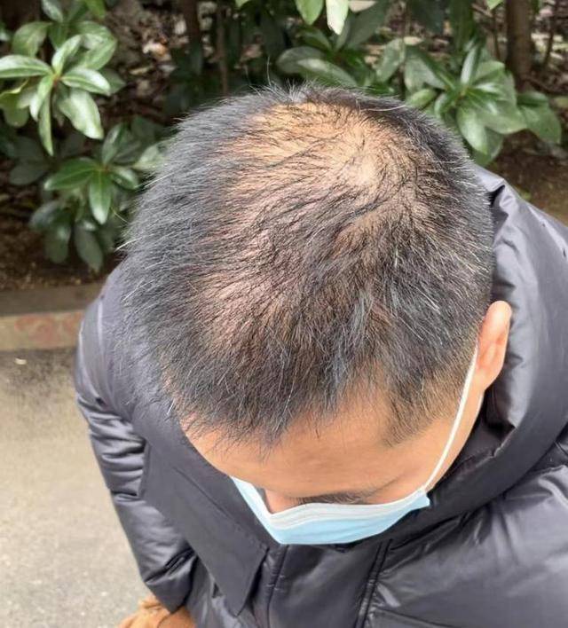 “还能反光<strong></p>
<p>贵金属kdj指标详解</strong>！”长沙男子植发近9月称后脑勺“像狗啃过”