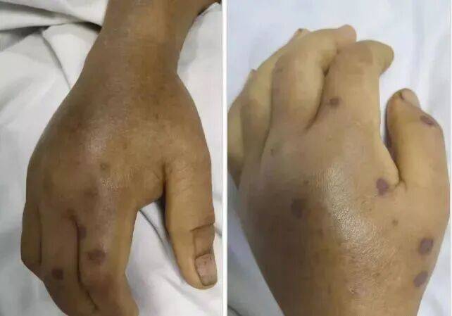 深圳一市民突遭马蜂围袭！已进入高发期<strong></p>
<p>数字货币交易APP下载</strong>，千万别招惹！