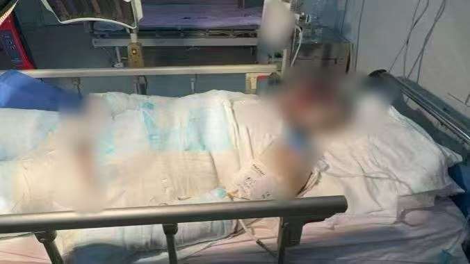 父子在哈尔滨一亲戚公司上班遇爆炸全身烧伤<strong></p>
<p>数字货币交易APP下载</strong>，治疗花费近百万公司拒赔偿？亲戚回应