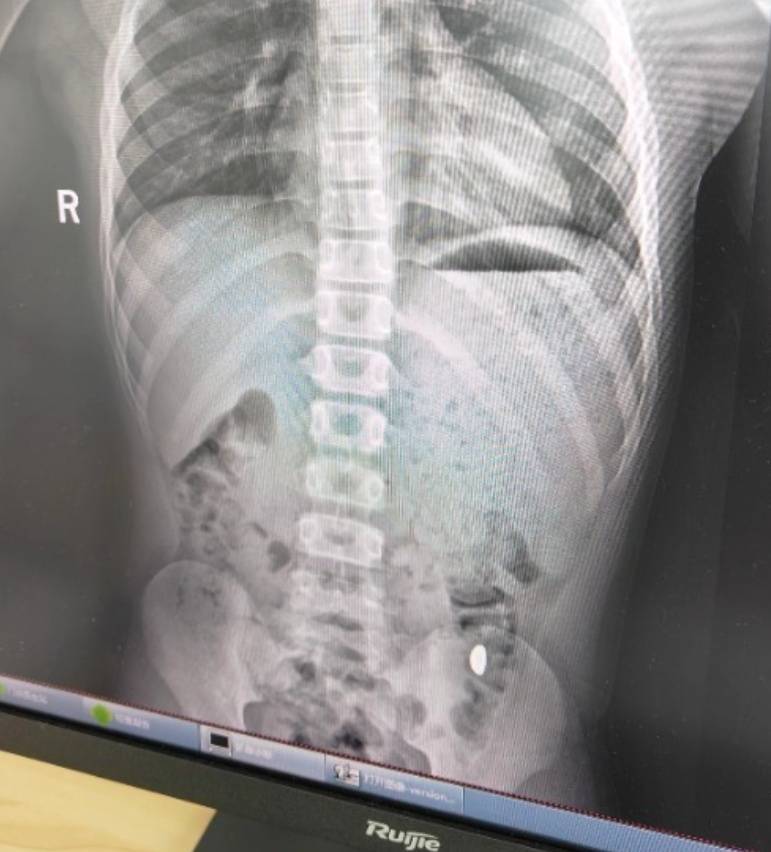 “熊孩子”误吞10克重金豆<strong></p>
<p>数字货币价格</strong>，妈妈：天天叮嘱他不要在外面拉屎