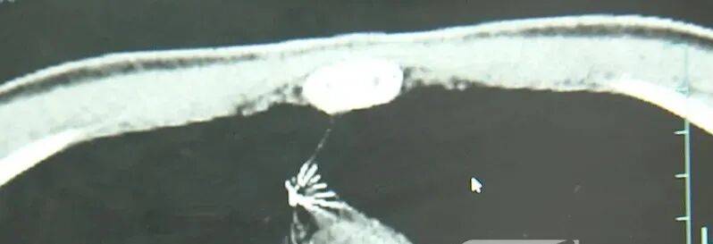 17岁小伙参军体检发现胸腔内有根5cm缝衣针<strong></p>
<p>平安证券交易行情</strong>,父母回忆或是1岁时扎入,取出时已锈迹斑斑