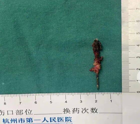 17岁小伙参军体检发现胸腔内有根5cm缝衣针<strong></p>
<p>平安证券交易行情</strong>,父母回忆或是1岁时扎入,取出时已锈迹斑斑